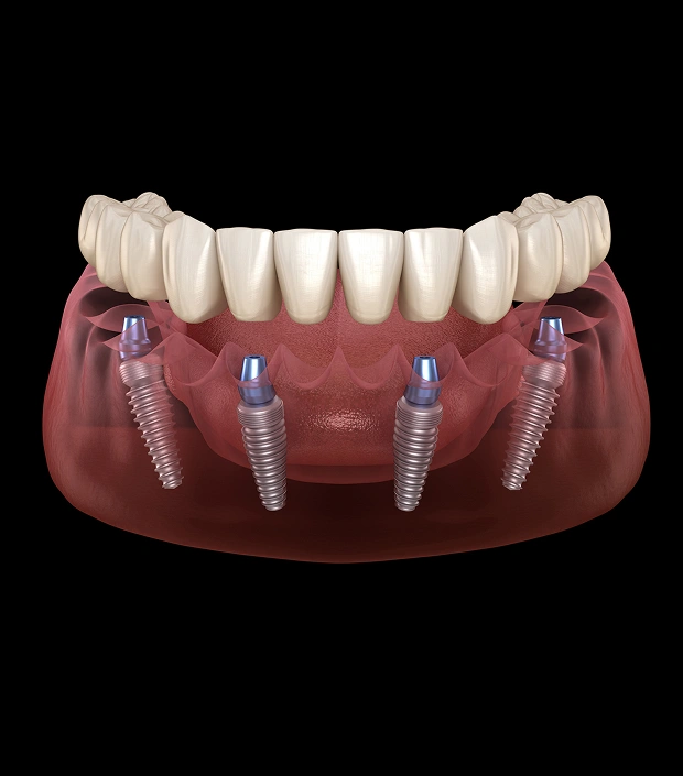 img-all-on-4-dental-implants
