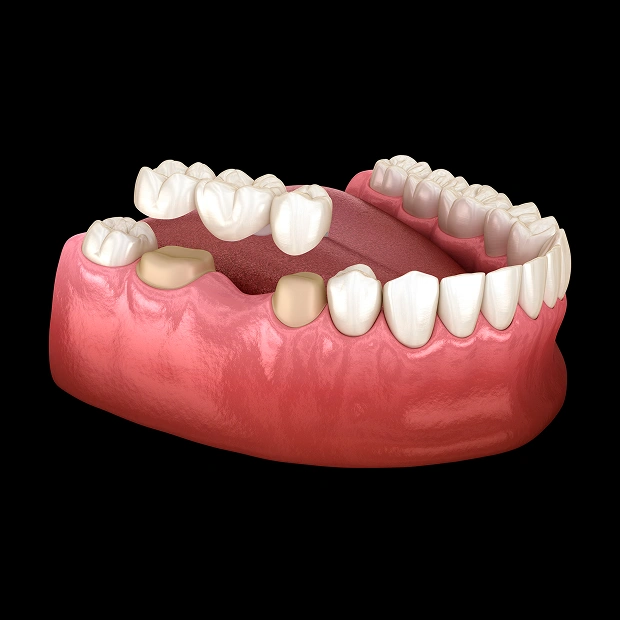 img-dental-bridges