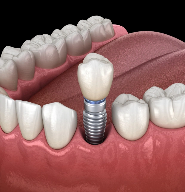 img-dental-implants
