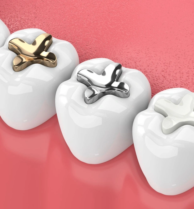 img-tooth-colored-fillings