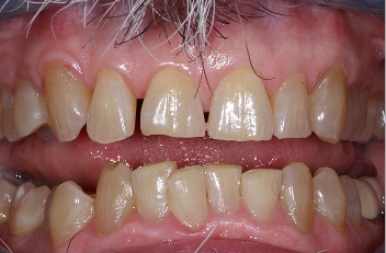 Dental Cleanings in Iowa City