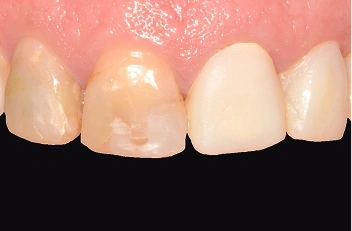 Fluoride Treatments in Iowa City
